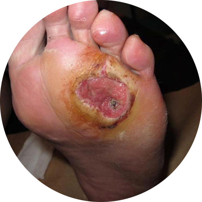 Diabetic-foot-ulcer